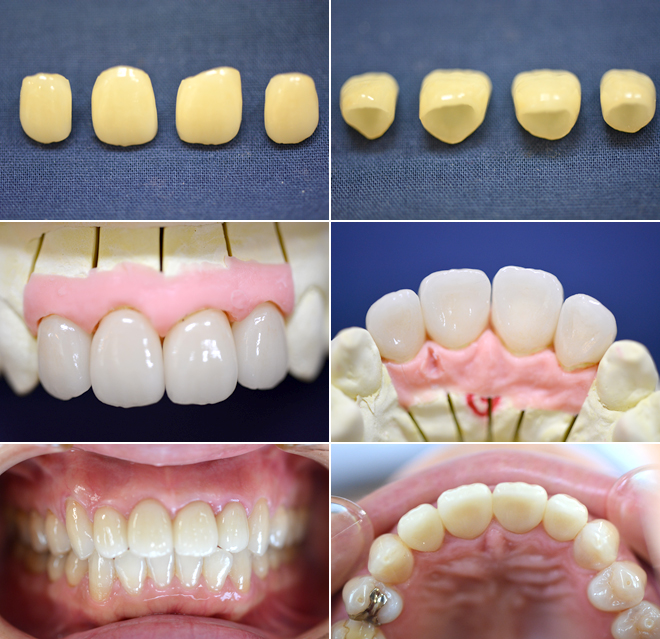 【絶版】金属焼付ポーセレン臼歯部の審美的表現法 歯科技工 セラミック 2b530e80c7d0de90885e285c5d7980